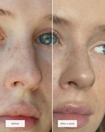 Hydrocolloid Overnight Nose Patches