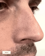 Hydrocolloid Overnight Nose Patches