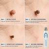 Pure Skin Spot Removal Roller