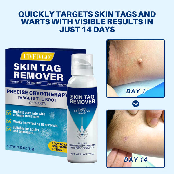 Fivfivgo® TagRecede Cryo Spray| Fast Skin Tag Remover
