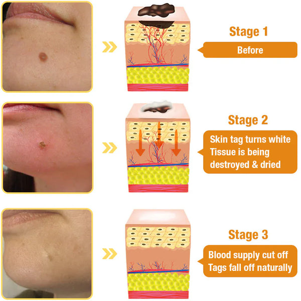 Bee poison treatment spray