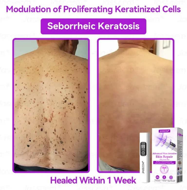 Advanced Non-Invasive Skin Repair CO₂ Laser Pen