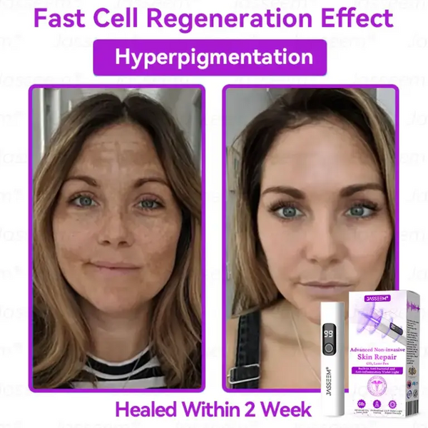 Advanced Non-Invasive Skin Repair CO₂ Laser Pen